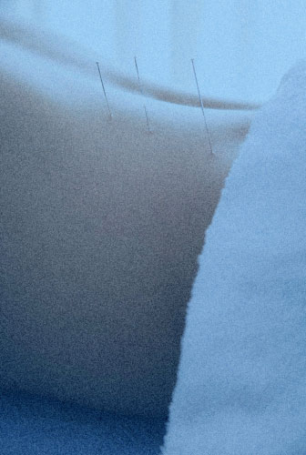 dry needling