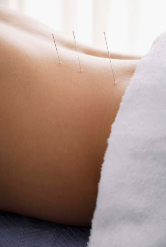 dry needling